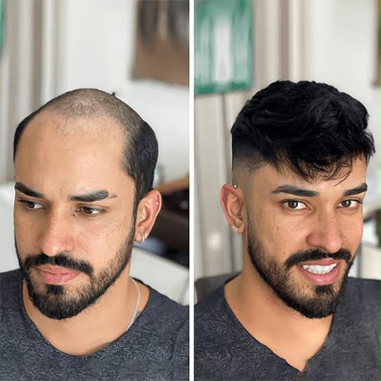 Women Hair Replacement Before After