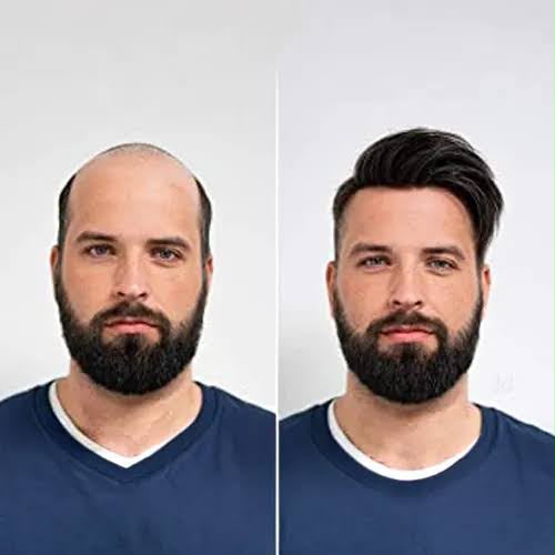 Hair Bonding Before After